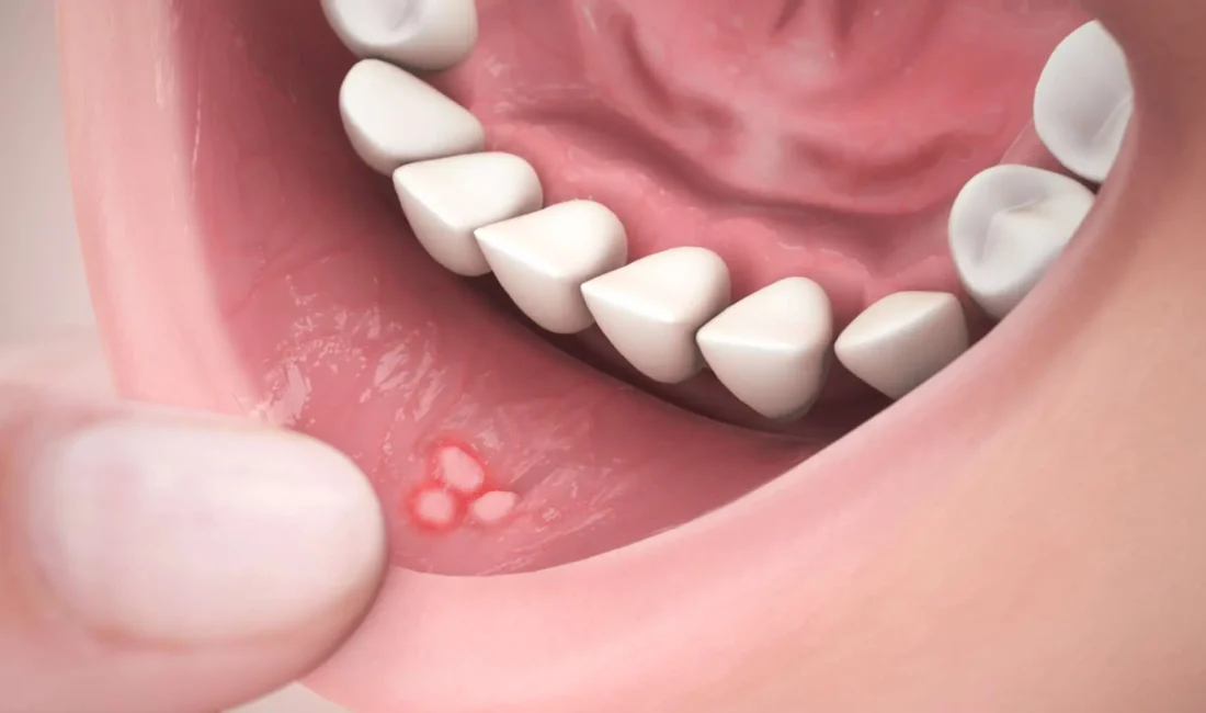 Aft oluşumunun önüne geçmek mümkün! Özellikle kış aylarında görülen aftların